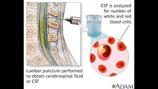 CSF analysis [upl. by Akemaj]