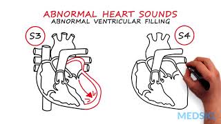 Abnormal Heartsounds and Murmurs Which heart sounds should worry you [upl. by Vladi886]