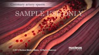 Acute Coronary Syndrome and Heart Attack [upl. by Akkahs]