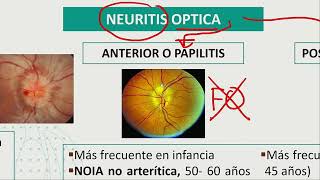 Oftalmología  Defectos campo visual Neuritis optica Degeneracion macular asociada a la edad [upl. by Ludovick]