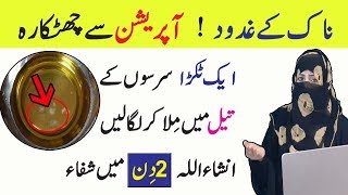 Causes  Symptoms Treatment of Nasal polyps in Urdu  Anam Home Remedy [upl. by Venice]