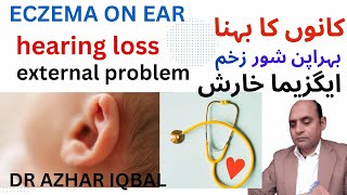 EAR ECZEMAHEARING LOSSSEXTERNAL EAR PROBLEMS KA HOMOEOPATHIC ILAJ [upl. by Cherise359]