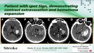 Intracerebral Hemorrhage by Sebastian Koch MD [upl. by Ammann981]