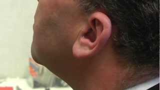 A closer look at the invisible Phonak Nano in the ear hearing aid [upl. by Jobye]