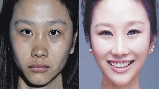 Use Skinlite Cream without side effects to get Fair Skin Hindi [upl. by Ardnat636]