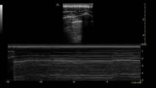 Pneumothorax [upl. by Maximo]