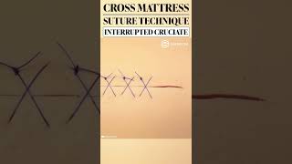 Cross Mattress Suture Technique aka Cruciate shorts education training suture medical surgeon [upl. by Rayshell]