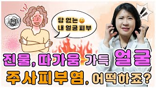 대구 주사피부염 진물 흉터 열감 따가움 가득한 붉은얼굴🥵 외출도 눈치보여 집에만😣  지루성피부염 가려움 홍조 울산부산창원포항구미안동경주마산밀양 청담미한의원 [upl. by Elleyoj]