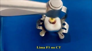 Preparo do Canal Radicular  Sistema Protaper Universal [upl. by Eesdnil541]