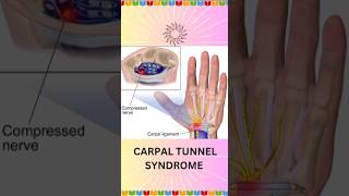 CARPAL TUNNEL SYNDROME hand carpaltunnelsyndrome physiotharapy exercisesanatomyteststretch [upl. by Ahtelra]