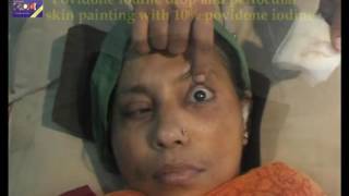 PERIBULBAR BLOCK  Cataract Surgery  DrSamar Basak [upl. by Begga557]