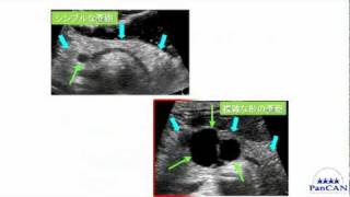 膵がん早期発見のための超音波検査3m2p [upl. by Ehcor]