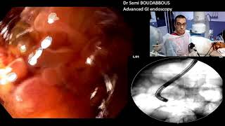 ERCP for severe acute cholangitis [upl. by Ymrots]