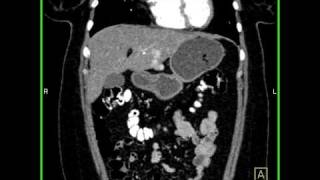 Abdomen Liver Focal Nodular Hyperplasia CT Angiography3 of 6 [upl. by Nerhtak]