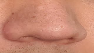 how to get rid of nose acne scars and bumps [upl. by Enilemme]