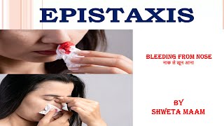 Episaxis causes signs and symptoms diagnosis and treatment BY SHWETA MAAM [upl. by Julide]