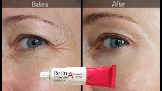 5Year RetinA Update  Before amp After for Wrinkles amp AntiAging [upl. by Jens]