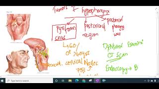 carcinoma of hypopharynx  ENT [upl. by Kata]