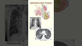 Bronchiectasis  Quick Facts [upl. by Athalia]