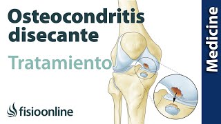 Pasos a seguir en el tratamiento si tienes Osteocondritis disecante [upl. by Norreht171]