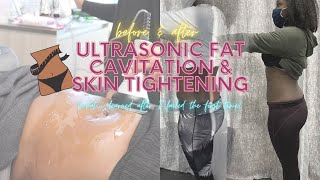 Ultrasonic Fat Cavitation amp Laser Lipo Before and After Review What I Learned After 5 Sessions [upl. by Itaws]