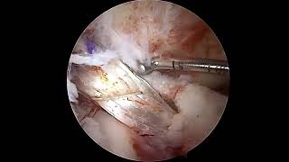 How is a torn Anterior Cruciate Ligament seen on Arthroscopy and How it is reconstructed [upl. by Eetnod]