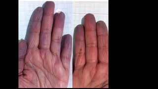 Raynauds Phenomenon explanation in Hindi [upl. by Hart]