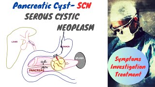 Serous Cystic Neoplasm Pancreas SCN [upl. by Alenoel101]