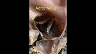 Aortic Valve  Semilunar valve of aorta [upl. by Xeno]