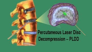 PLDD  Percutaneous Laser Disc Decompression [upl. by Delfine]