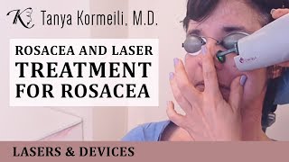 Rosacea and laser treatment for rosacea [upl. by Ettenej]