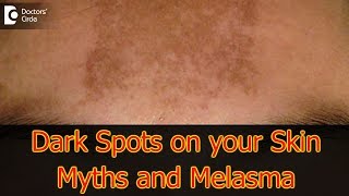 Dark Spots on your Skin  Hormones Vitamin D Melasma  Dr Aruna Prasad [upl. by Major]