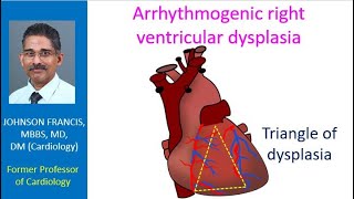 Arrhythmogenic right ventricular dysplasia [upl. by Euqinor]