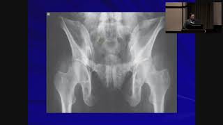 Pelvic and Acetabular Fractures  Anthony Spinnickie MD [upl. by Beverly963]