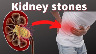 How long does it take to pass a kidney stone from the ureter [upl. by Sandry]