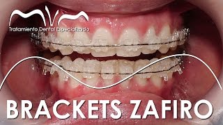 TODO SOBRE LOS BRACKETS ZAFIRO  ¿YA TE DECIDISTE [upl. by Ennairda244]