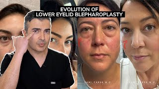 Evolution of Lower Eyelid Blepharoplasty  Dr Parsa Explains Trifecta Lift [upl. by Dixon]