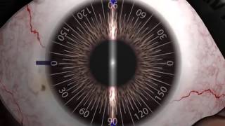 Auroflex Toric Marking amp Implantation guide [upl. by Shannon]