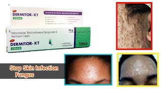 How to use Dermitor KT Cream  Beclomethasone Ketoconazole Dipropionate Neomycin  Antifungal [upl. by Nets]