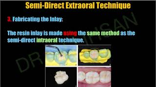 Techniques of posterior composite inlayonlay restoration  operative 4 Lec 11 [upl. by Annelak]