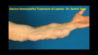 Electro Homeopathic medicine for lipoma  charbi ki ganth ka ilaz  Dr Sachin Tyagi [upl. by Otit661]