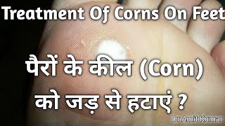 Treatment Of Corns On Feet  पैरों के कील को जड़ से हटाएं पैरों के कील का इलाज [upl. by Sheila]