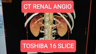 CT Renal Angiogram on Toshiba 16 Slice [upl. by My]