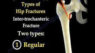 Hip Fractures Types and fixation  Everything You Need To Know  Dr Nabil Ebraheim [upl. by Teevens]