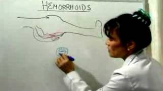 Hemorrhoid Cure What Causes Hemorrhoids [upl. by Ecydnac]