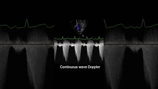 Understanding Dynamic and Fixed Obstruction in TOF shorts echocardiography ultrasound pediatrics [upl. by Hultgren403]