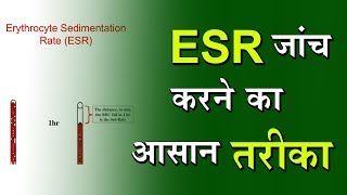 Blood Test Erythrocyte Sedimentation Rate ESR  By DPMI [upl. by Zucker]