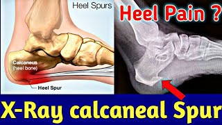 How to read Calcaneal spur or Heel spur in xRay । एड़ी के दर्द का कारण  Uday Xray [upl. by Curtice409]