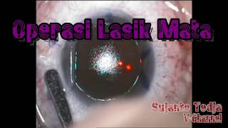 Operasi Lasik Mata Terbaru yang Dicari Mereka yang Berkacamata [upl. by Dearborn]