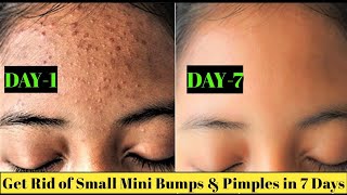 Get Rid of Tiny Bumps on Face and Foreheads100 Cured in Simple Home RemediesBE HAPPY TAMIL [upl. by Yesnnyl906]